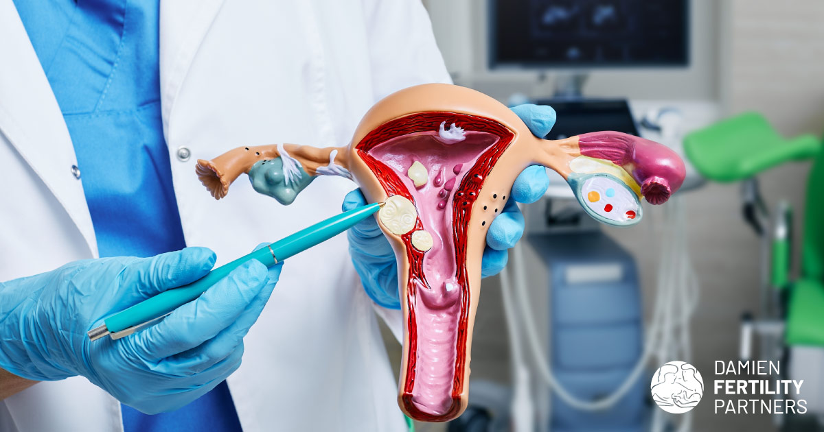 medical provider shows model of uterus with fibroids