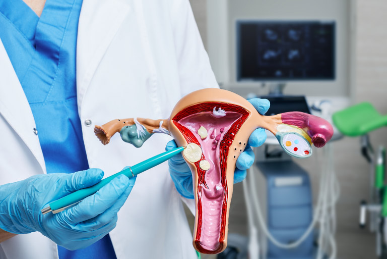 medical provider shows model of uterus with fibroids